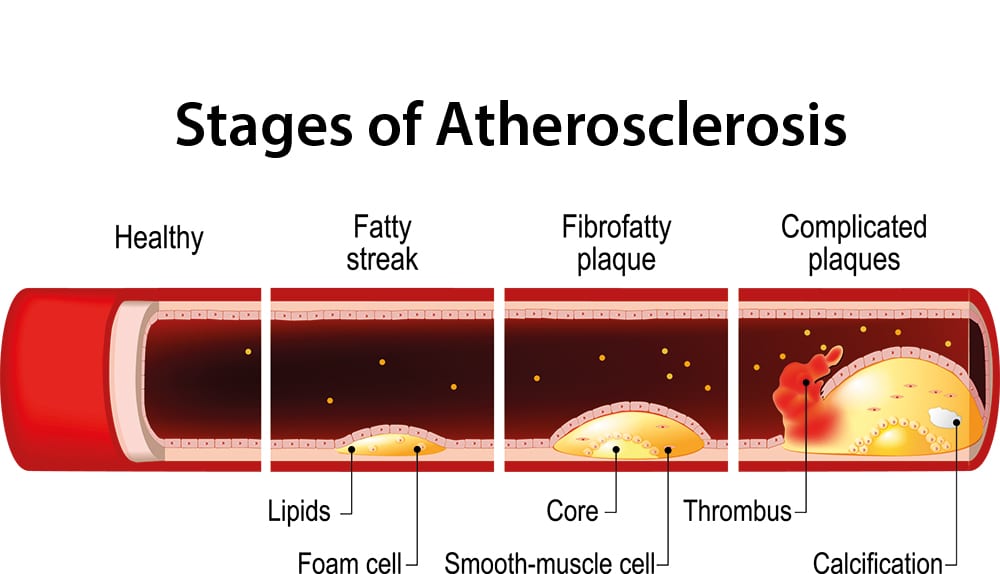 Stages of atherosclerosis infograph.