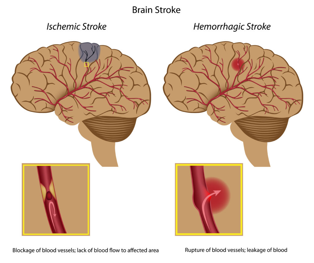 Info-graph detailing the two different types of strokes.