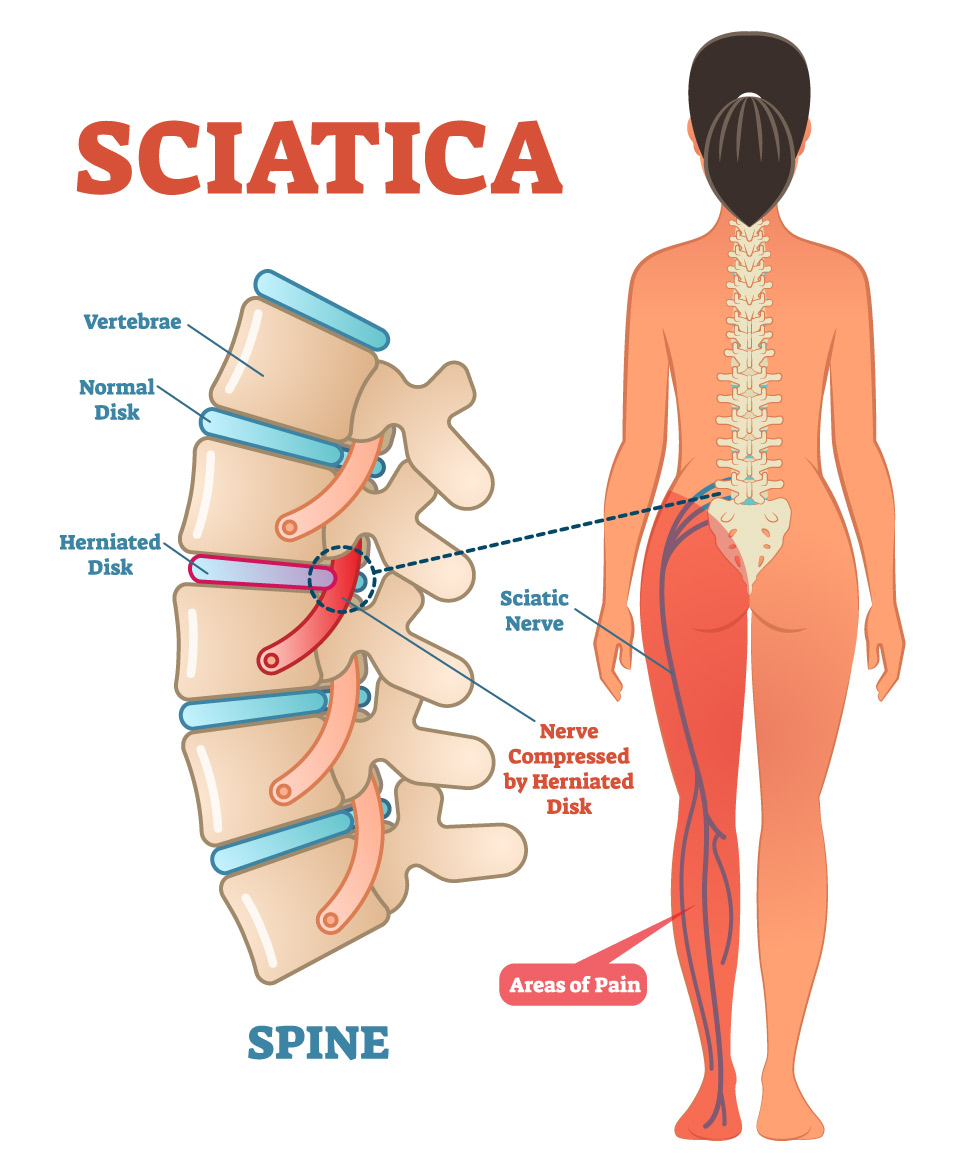 Diagram explaining how a slipped disk causes sciatica