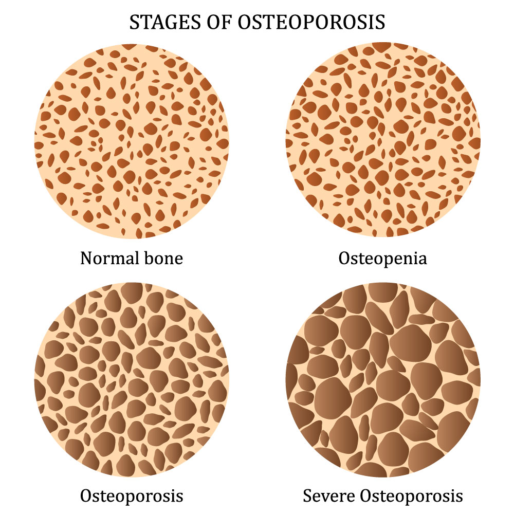 Infograph explaining the stages of osteoporosis in bone density.