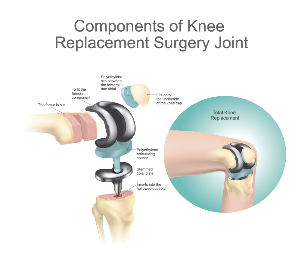 Knee replacement diagram